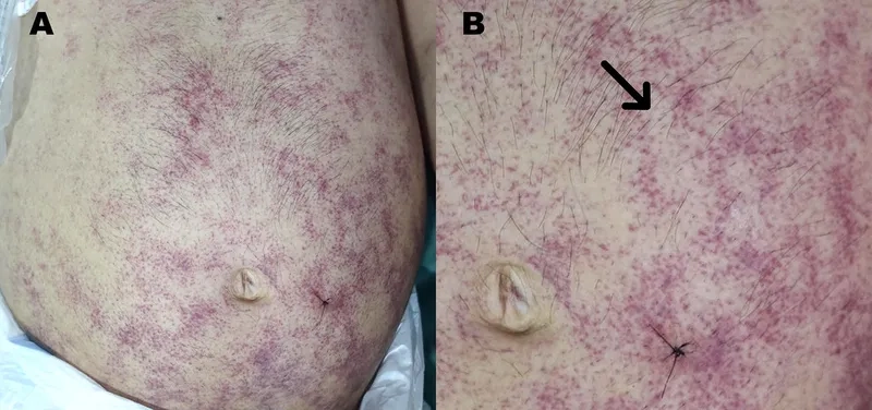 A visual guide to common strongyloidiasis symptoms