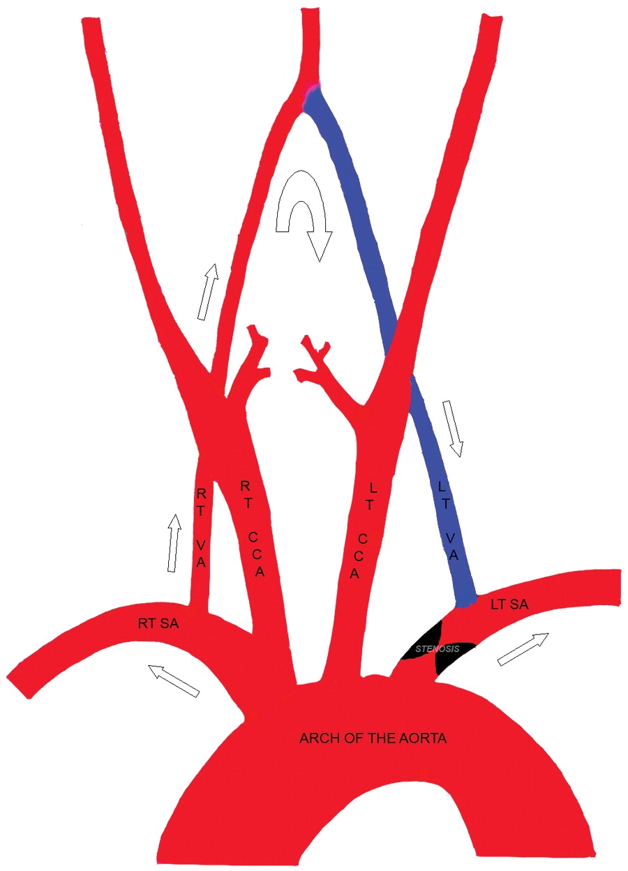 Deep vein thrombosis DVT and hidden dangers