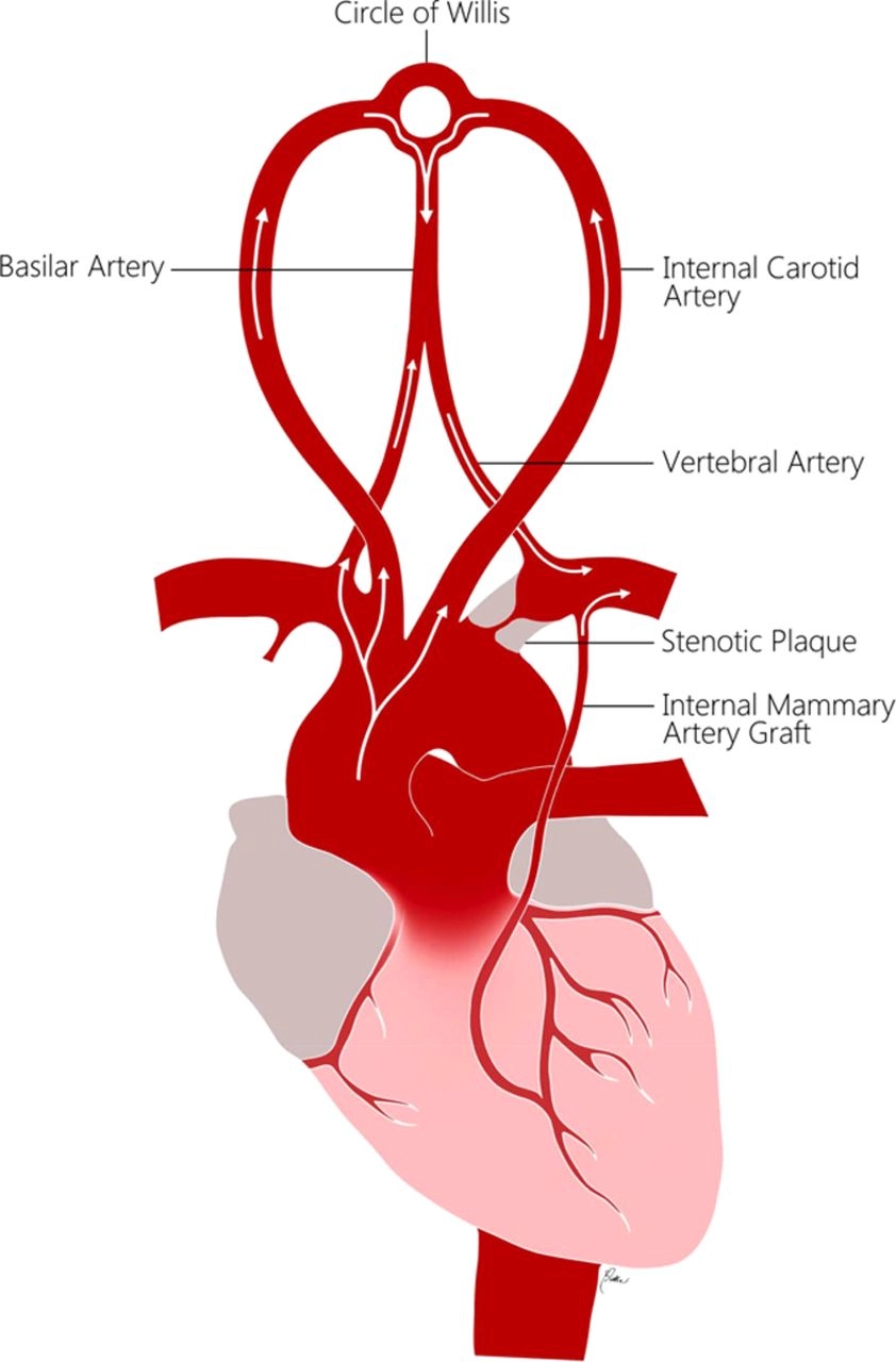 Illustration of serious complications from aneurysm