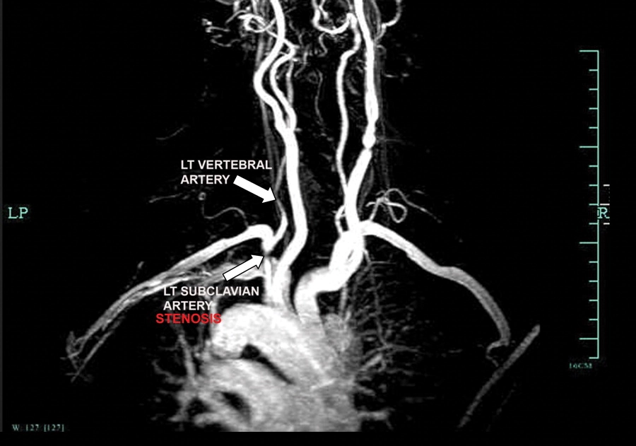 Peripheral artery disease PAD and blocked vessels