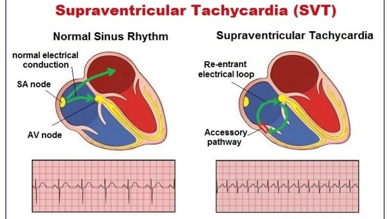 Supraventricular Tachycardia vs sinus tachycardia shows key differences
