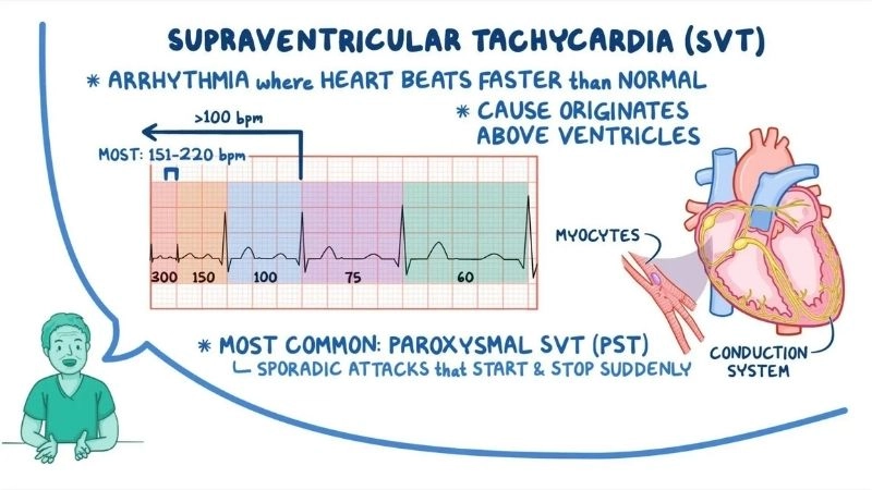 Supraventricular Tachycardia during exercise needs careful medical guidance