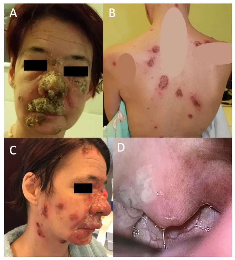A clinical chart of common syphilis symptoms