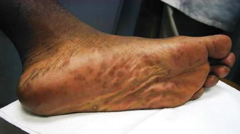 Microscopic view of the bacterium Treponema pallidum