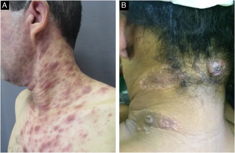 Infographic detailing modes of syphilis transmission