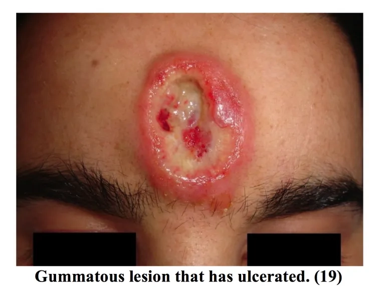 Close-up image of a primary syphilis chancre