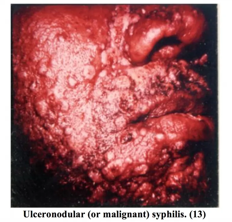 Diagram answering the question: what is syphilis