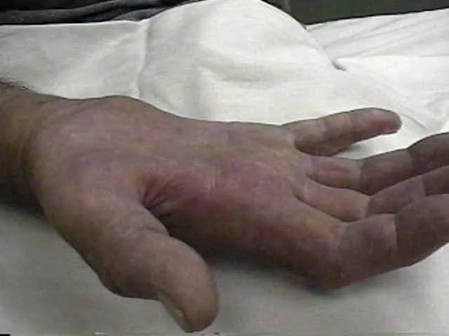 A before-and-after MRI following syringomyelia treatment