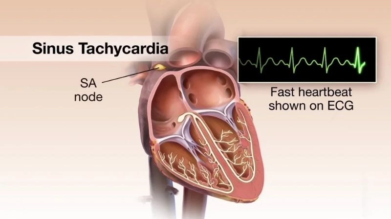 Ventricular tachycardia VT triggers dangerously rapid heart rhythm