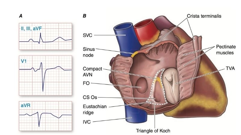 Sinus tachycardia is a naturally fast heartbeat from the sinus node