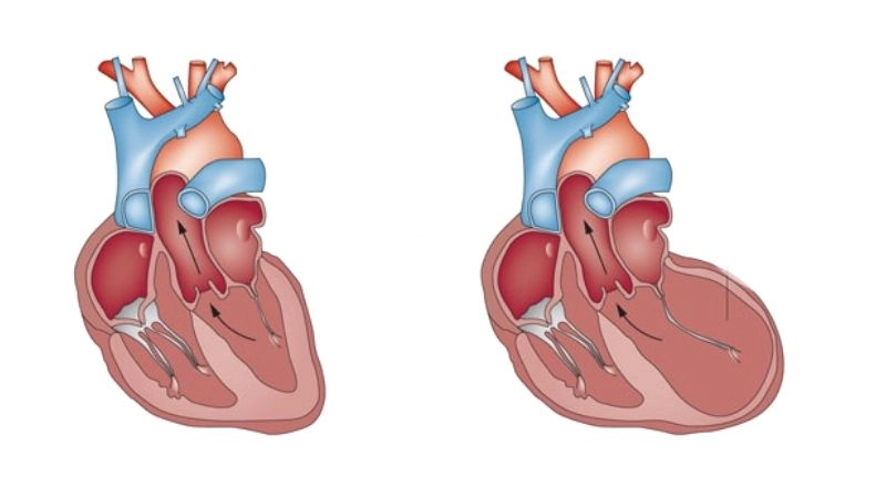 Tachycardia induced cardiomyopathy treatment managing rapid heart rate