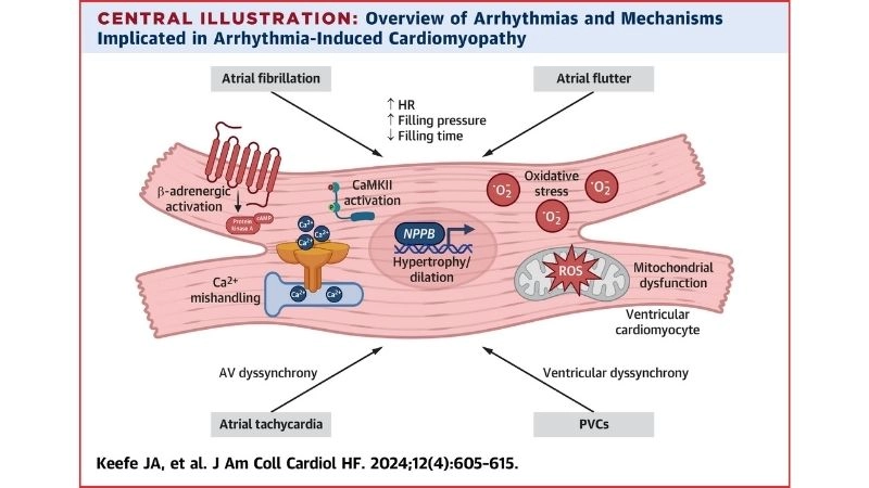 Causes of tachycardia induced cardiomyopathy common triggers identified