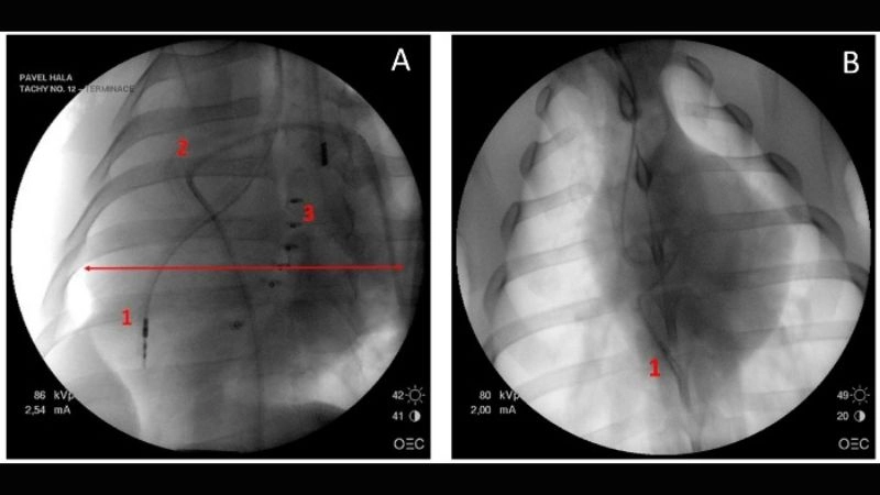 Tachycardia induced cardiomyopathy recovery improving heart health gradually
