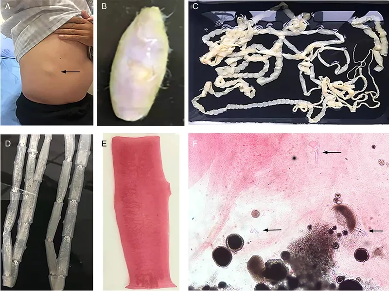 Explaining how do you get tapeworms
