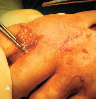 The cycle of tapeworm infection in humans