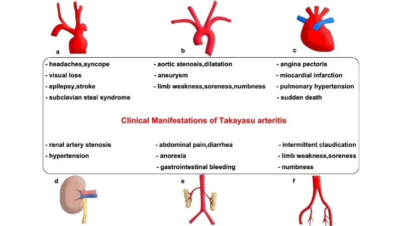 Takayasu's arteritis symptoms affecting major arteries