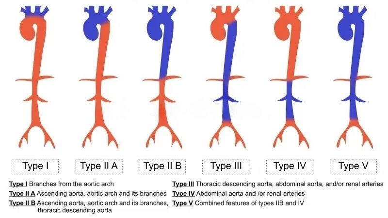 Takayasu's arteritis life expectancy and outcomes