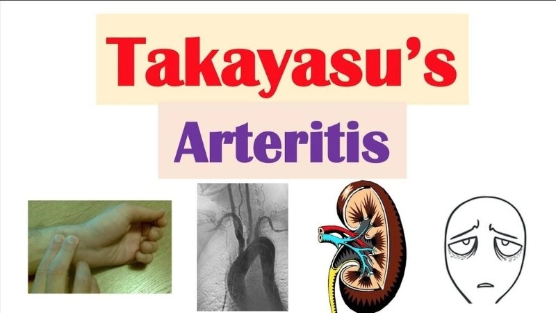Takayasu's arteritis and pregnancy health concerns