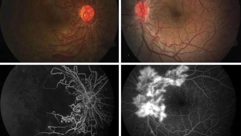 Takayasu's arteritis diet for better management