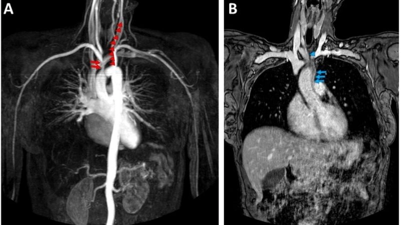 Takayasu's arteritis patient stories and journeys