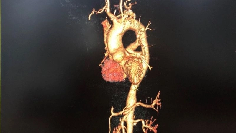 Takayasu's arteritis vs giant cell arteritis differences