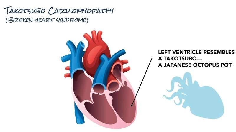 Broken heart syndrome causes triggered by emotional stress