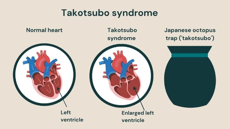 Takotsubo cardiomyopathy versus heart attack key differences