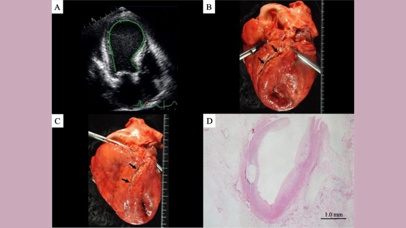 Takotsubo syndrome in women more common in female hearts
