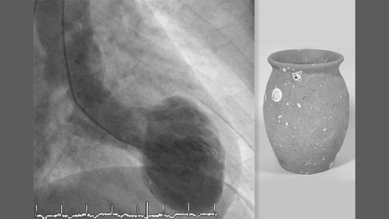 Takotsubo cardiomyopathy prognosis outlook for affected patients