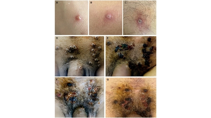 Tanapox is a human poxvirus infection case