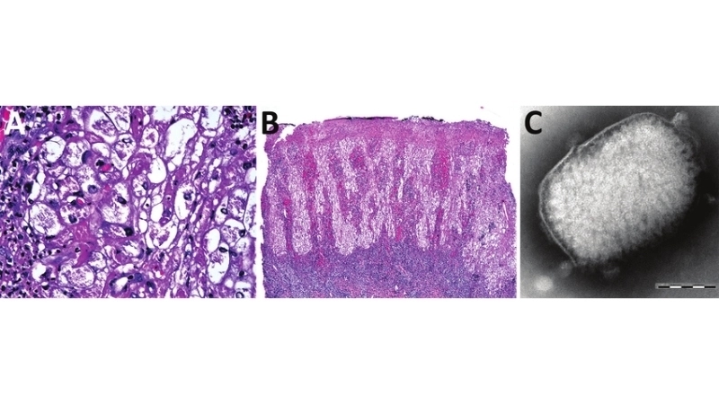 Tanapox symptoms include fever and skin lesions