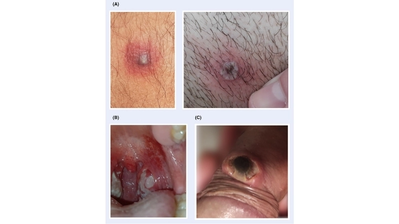 Tanapox is a zoonotic disease from monkeys