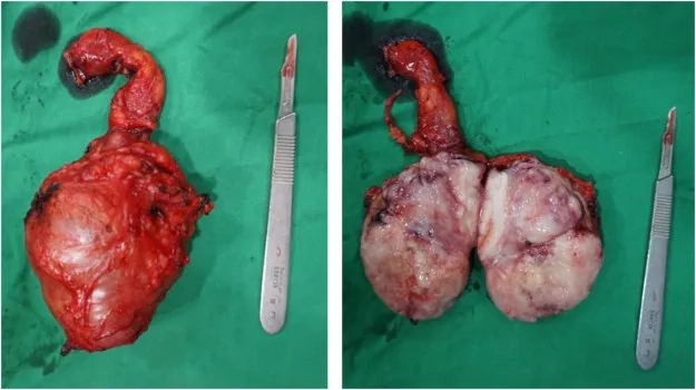 Doctor explaining what is testicular cancer