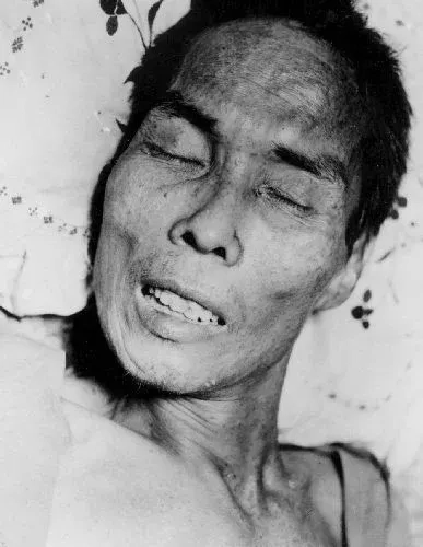 A medical guide explaining what is tetanus