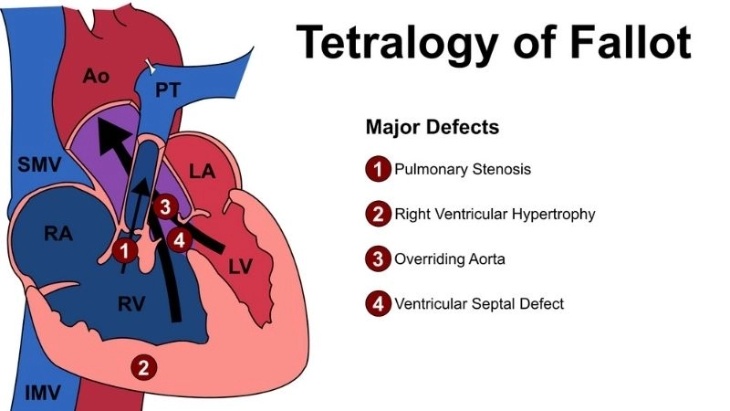 Tetralogy of Fallot surgery life saving heart repair procedure