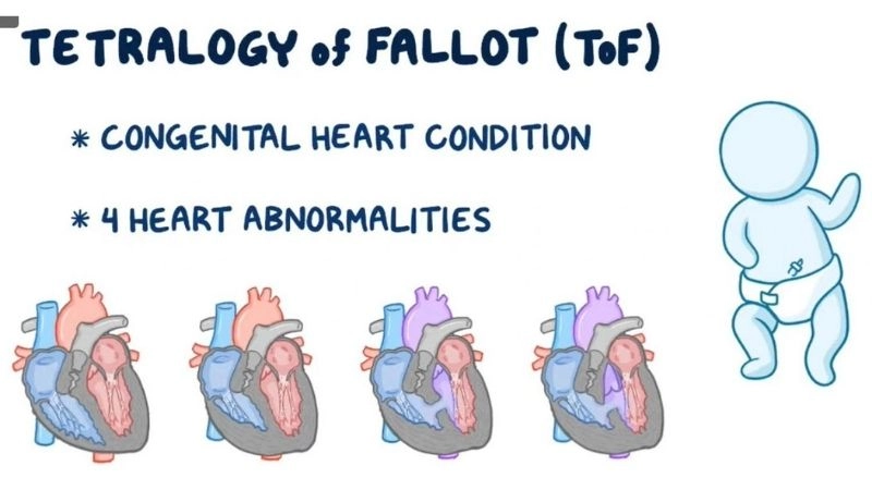 Tetralogy of Fallot treatment options to improve heart function