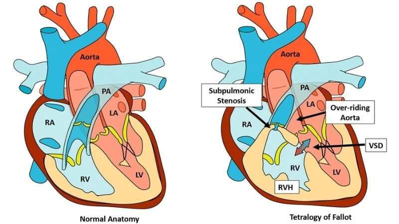 Tetralogy of Fallot causes congenital heart development issues