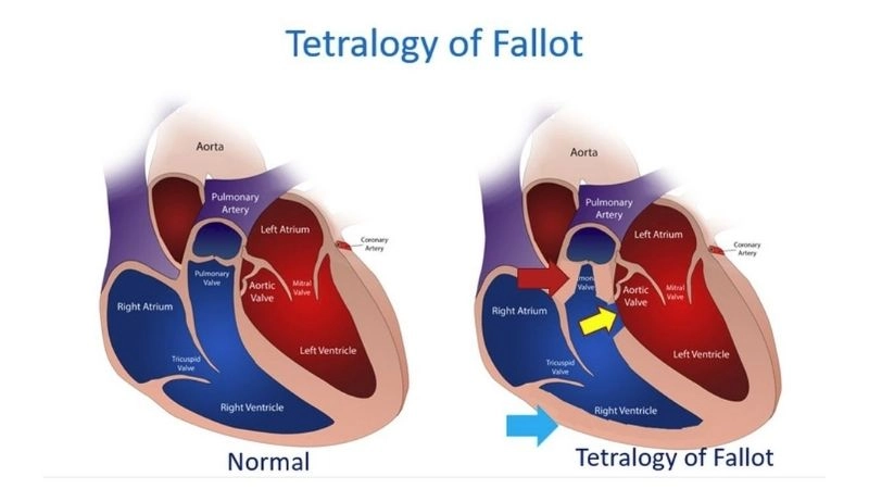 Tetralogy of Fallot in infants common presentation in newborns
