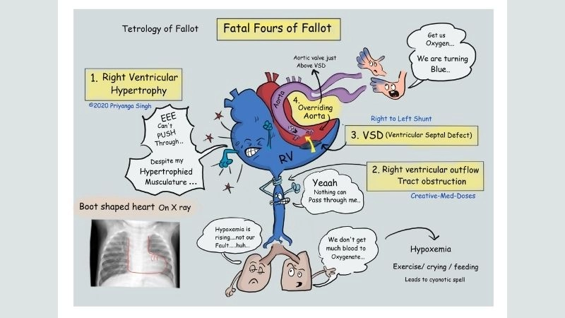 Tetralogy of Fallot repair restoring heart blood flow balance