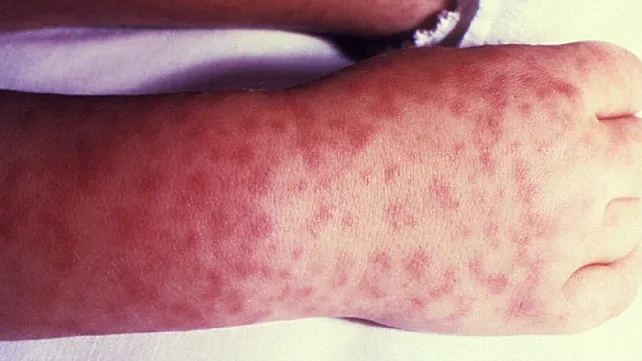 A hiker takes steps for prevention of Colorado tick fever