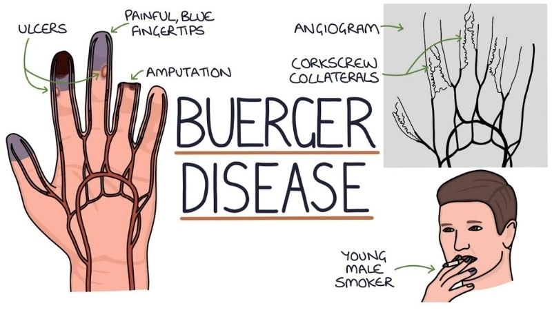 Accurate Buerger's disease diagnosis for early care