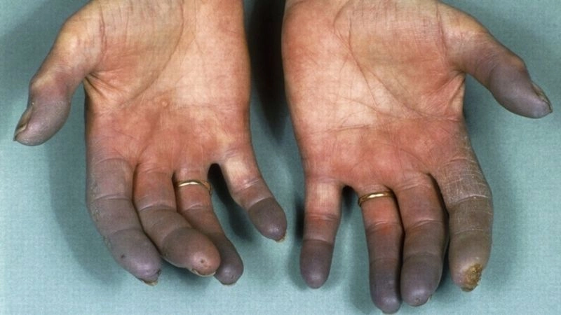 Raynaud's phenomenon and circulation complications