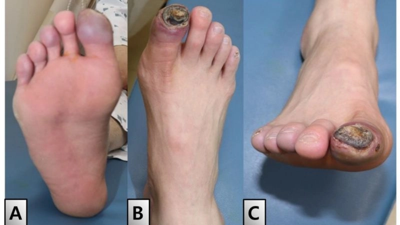 Buerger's disease prognosis and long term outlook