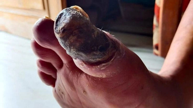 Peripheral arterial disease PAD and circulation risk