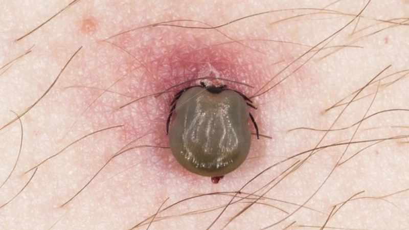 Protect your health using TBE vaccine now