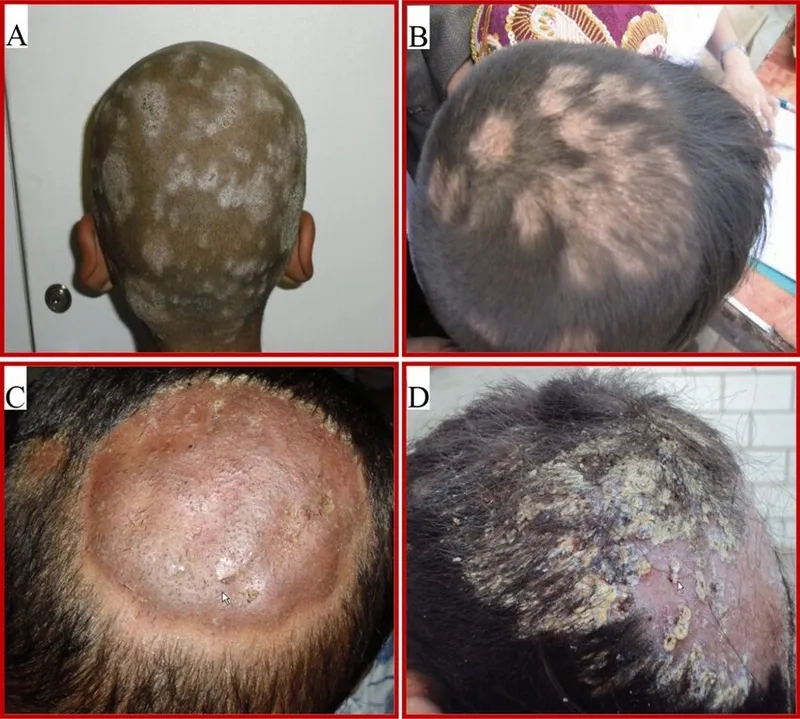 Using antifungal shampoo for tinea capitis