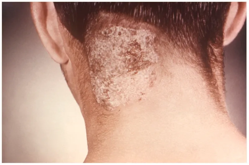 Showing the typical hair loss from ringworm