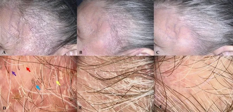 An overview of tinea capitis treatment options