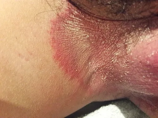 Clinical pictures of jock itch for reference