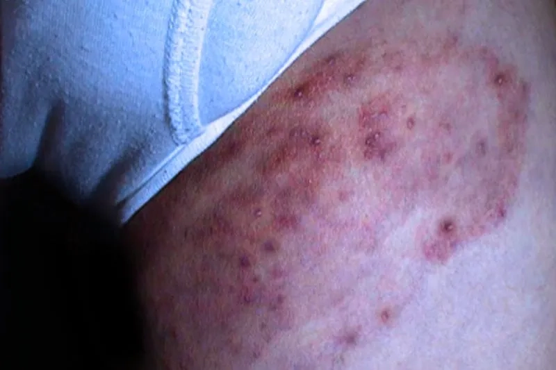 Common home remedies for jock itch relief